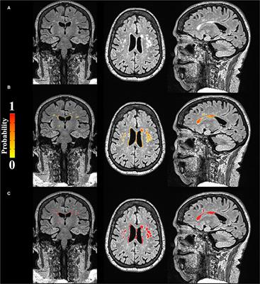 Neurovascular Coupling Is Impaired in Hypertensive and Diabetic Subjects Without Symptomatic Cerebrovascular Disease